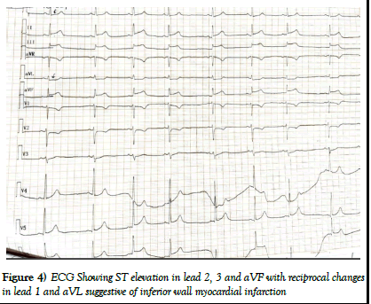 pulmtcr-x ray pulmtcr-x ray